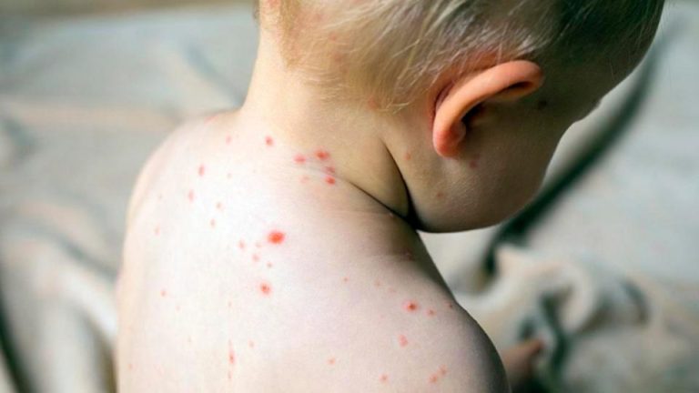Un bebé de 10 meses es el cuarto afectado en lo que va del año Confirman un nuevo caso de sarampión