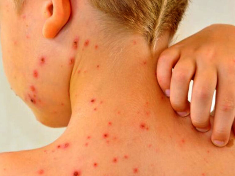 Nueva alerta por sarampión