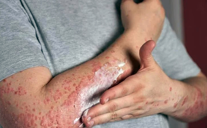 Salta confirmó 11 casos activos de lepra y hay alerta sanitaria en la vecina provincia